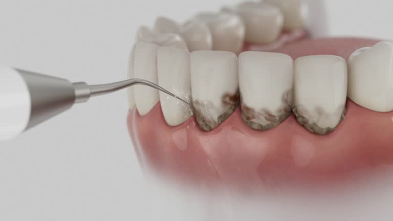 Reliable Dental Implants contractor in Morocco, IN by Smile Center Dentistry